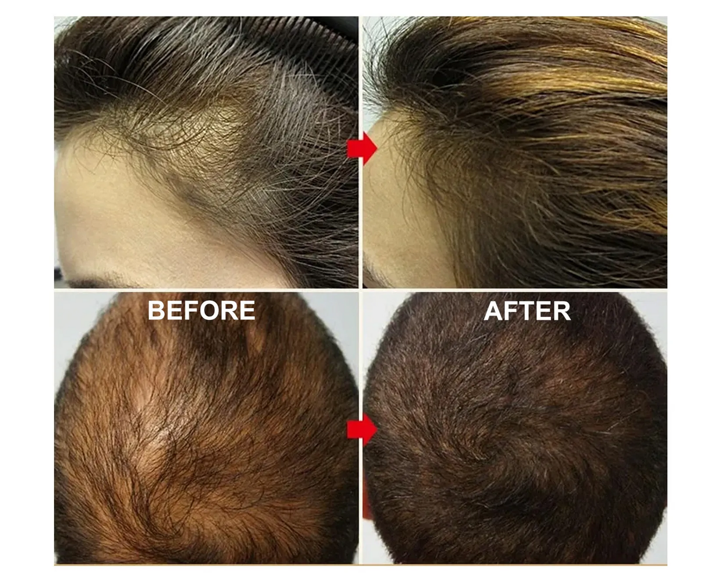 Rozemarijn olie™- Nooit meer last van kale plekken in je haar.